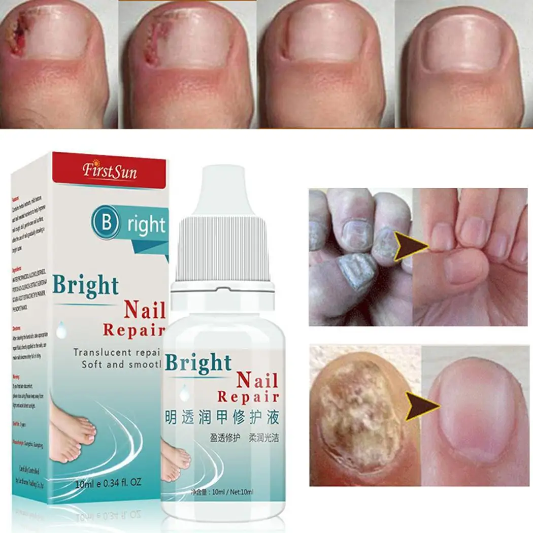 Травяная обработка грибка для ногтей содержит жидкую бутылку 10 мл экстрактов