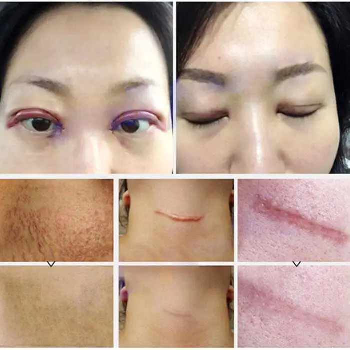New arrival Acne Scar Removal Cream 30g Natural Facial Skin Repair Stretch mark Treatment Whitening beauty tools | Красота и здоровье