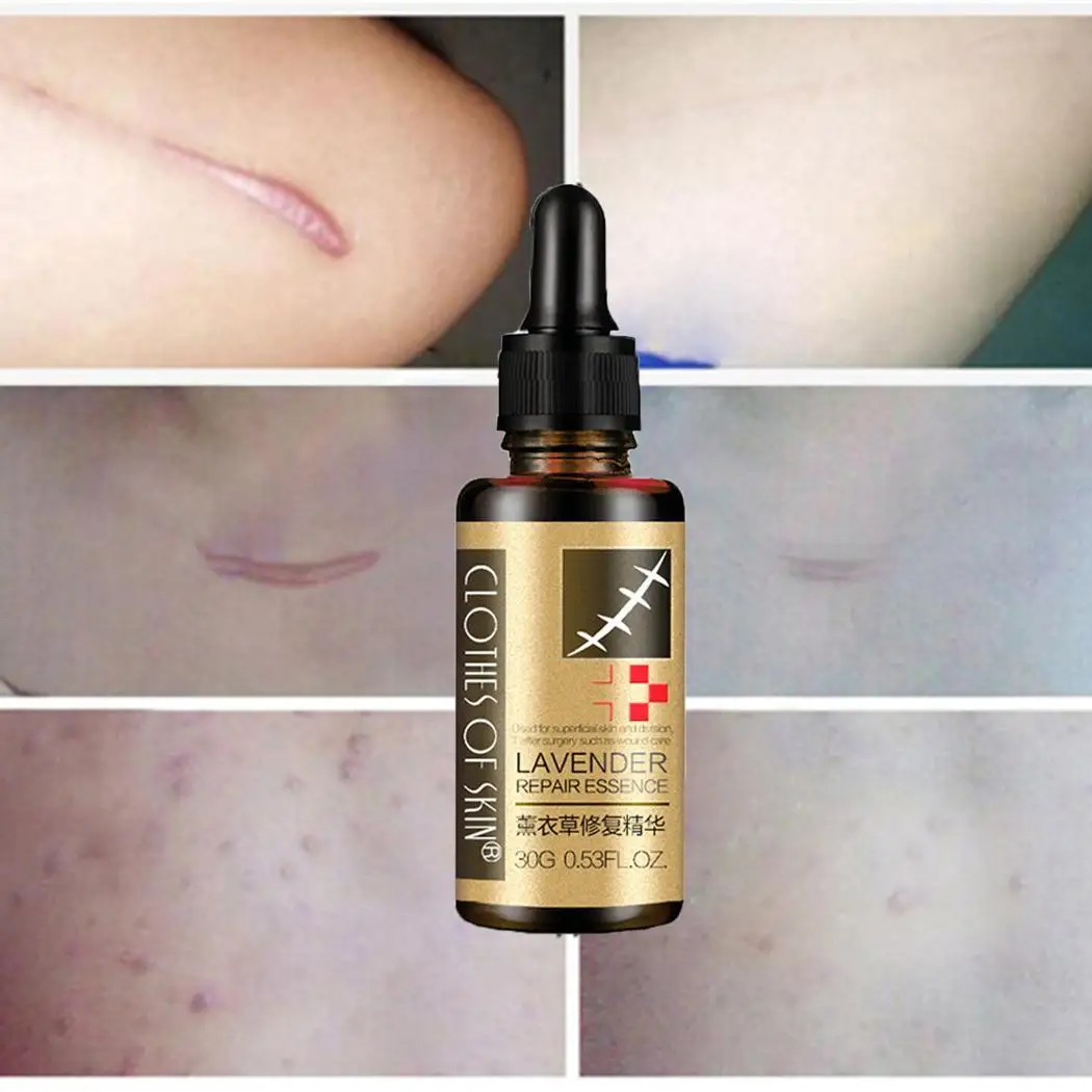 New arrival Acne Scar Removal Cream 30g Natural Facial Skin Repair Stretch mark Treatment Whitening beauty tools | Красота и здоровье