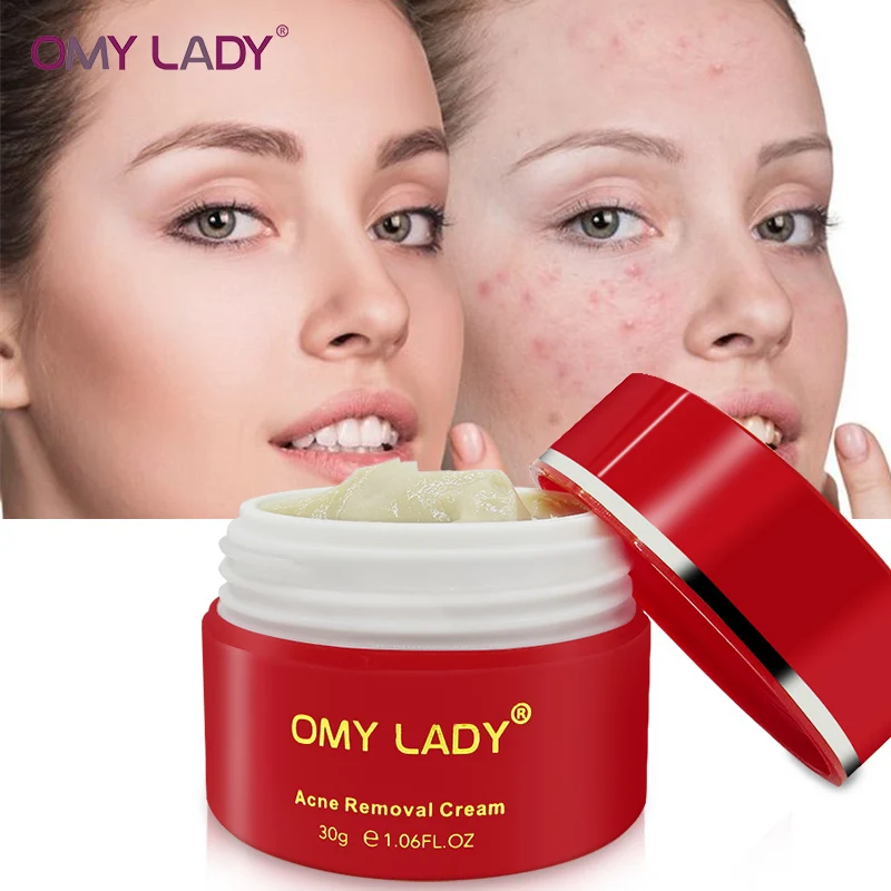 OMY LADY 100% растительная сыворотка лечение акне гель от очищающий крем для лица