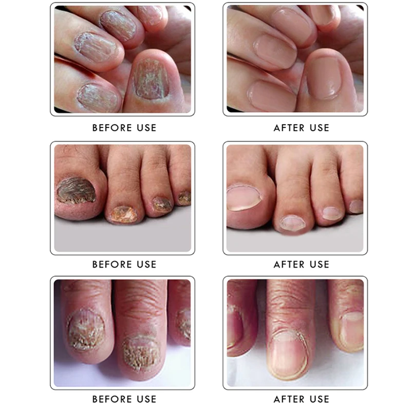 Nail Treatment Essential Oil Toe Finger Anti Fungus Nourishing Care Liquid | Красота и здоровье