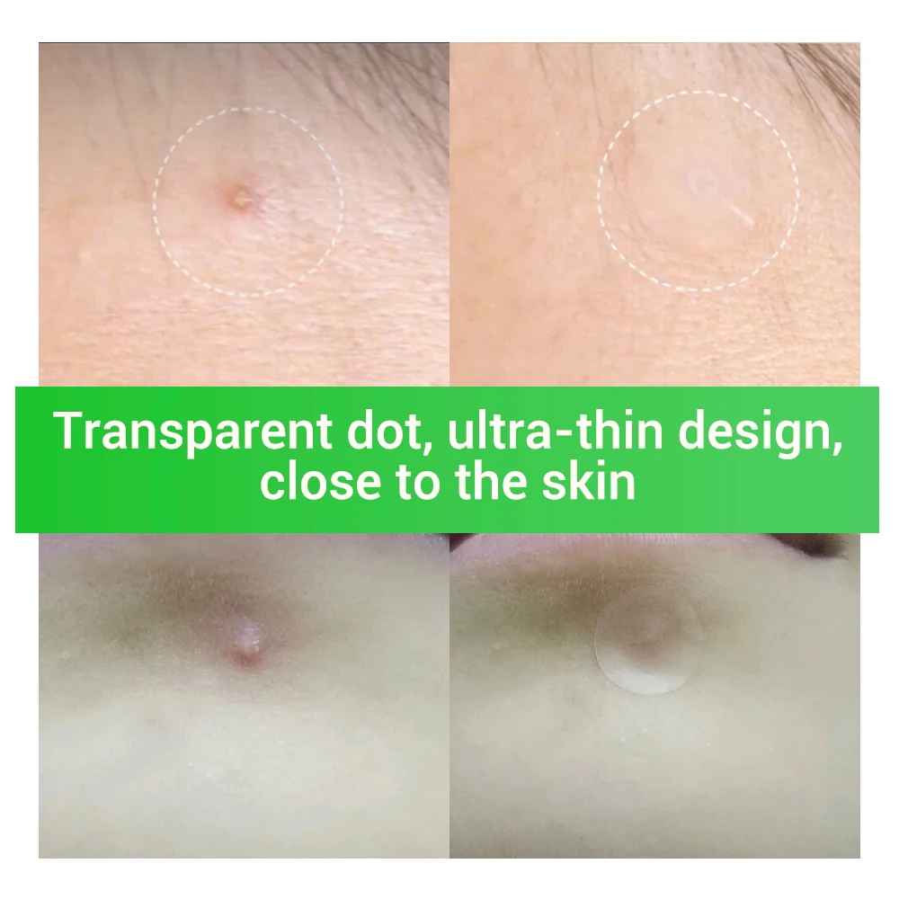 Breylee акне прыщи патч лечение наклейки для удаления прыщей инструмент пятен уход