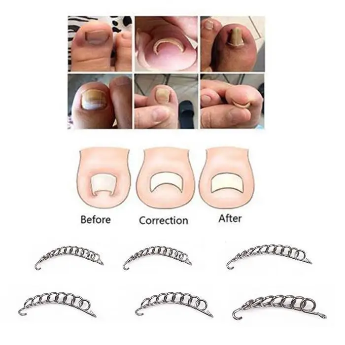 12pcs Professional Toe Nail Correction Wire Fixer Pedicure Paronychia Recover Toenails Corrector Foot Care Tool | Красота и здоровье