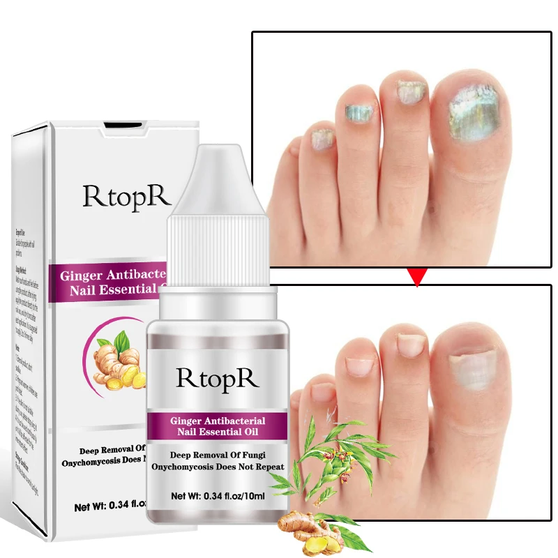 Nail Treatment Essential Oil Toe Finger Anti Fungus Nourishing Care Liquid | Красота и здоровье