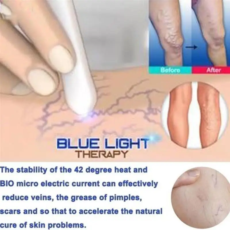 

Spider Vein Eraser Anti-varicose Veins Removal Pen for Anti-Inflammation Acne Scar Wrinkle Removal Treatment Skin Tightening