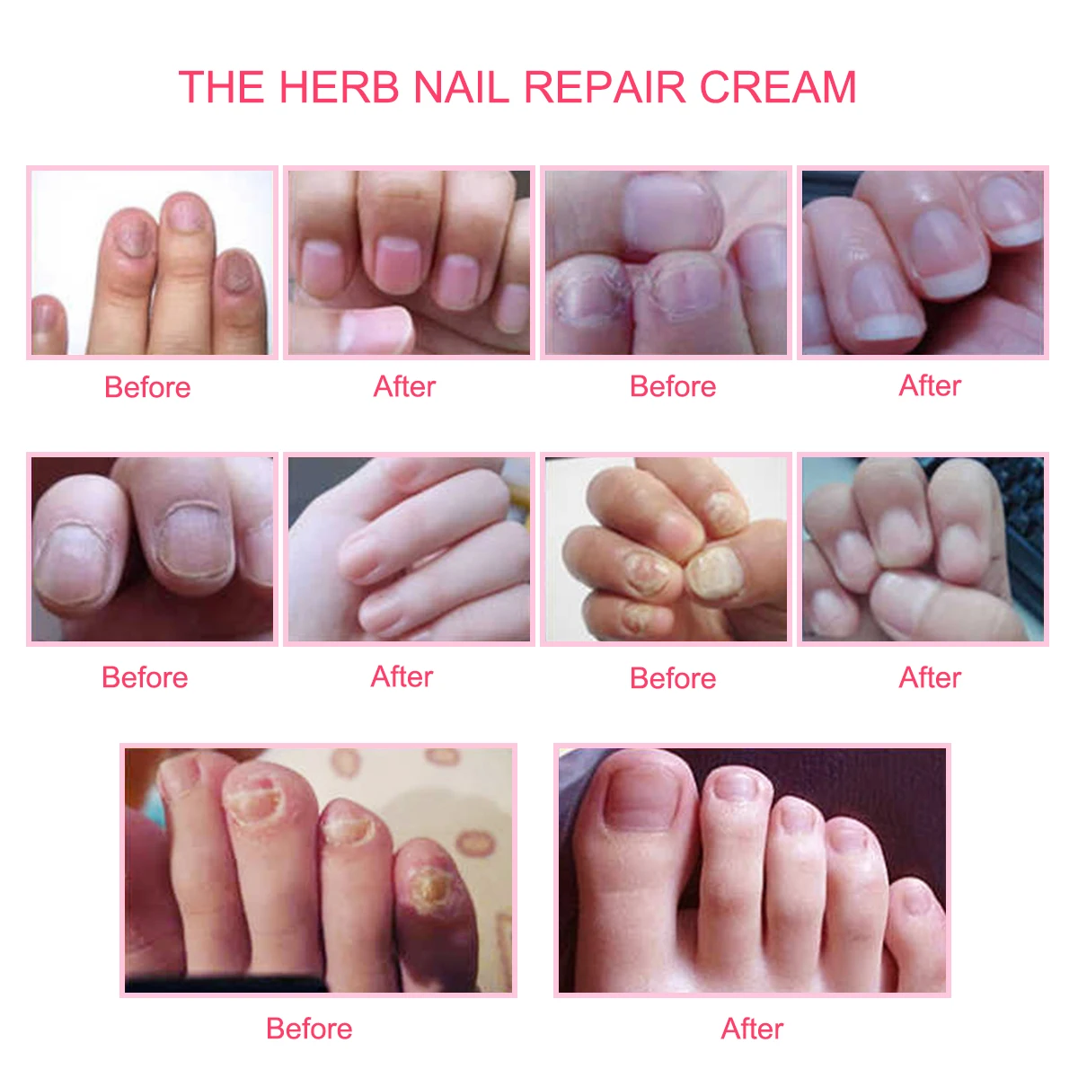 Monja 15 г травяной протектор для ногтей крем ухода за кожей гриб Paronychia Treatmen трав