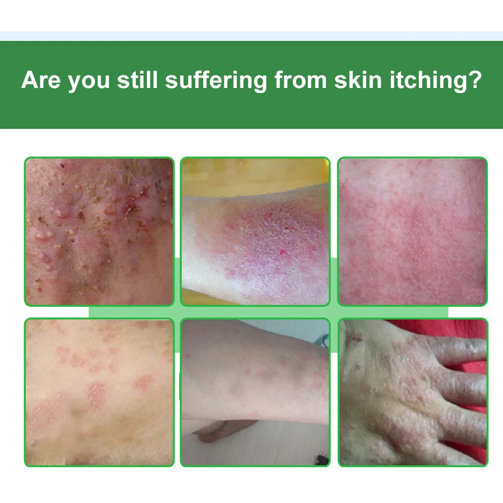 Мазь DUS Eczema Pruritus псориаз дерматит травяной крем от экземы для детей и взрослых
