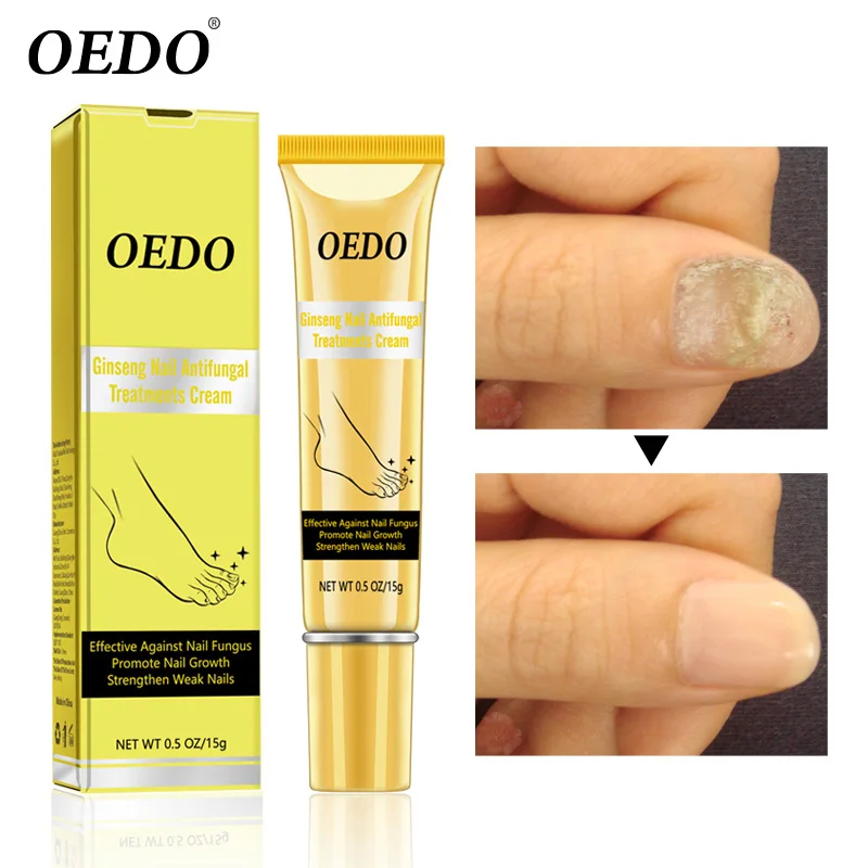 Женьшень ногтей противогрибковое лечение травяной крем удаление грибка ног анти