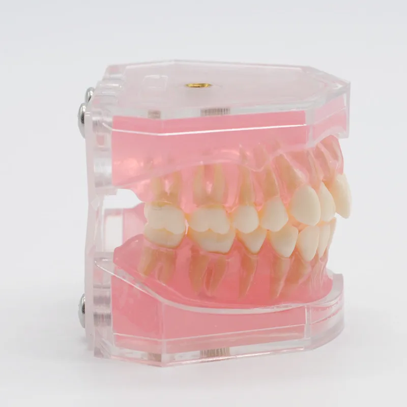 Стоматология лабораторная модель исследования зубов Overdenture Нижняя 4 имплантата