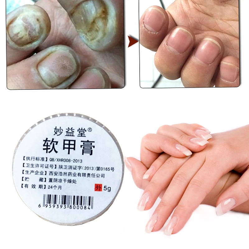 Высокоэффективный Китайский травяной крем для лечения грибка ногтей Onychomycosis Dead