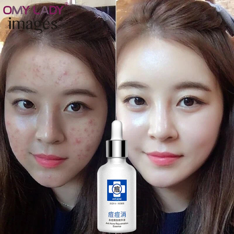 OMY LADY IMAGES acne treatmnet essence удаляет пятна от акне сыворотка натуральный и глубоко