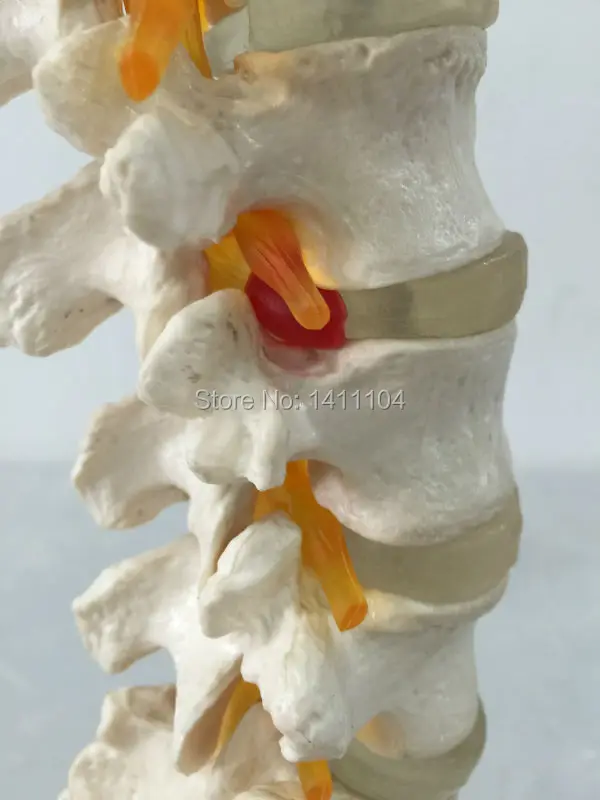 Бесплатная доставка и 5 поясничных крестцовых позвонков с креплением к нервам