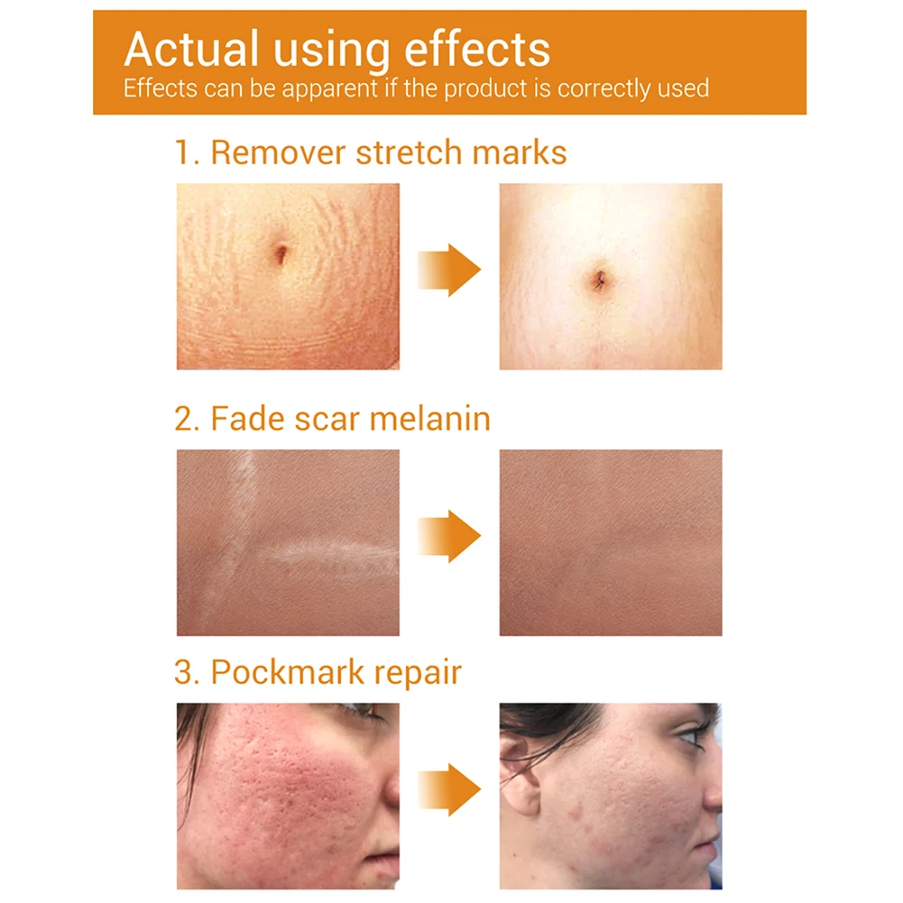 Средство для лечения акне с гиалуроновой кислотой 20 мл|Устройство ухода за кожей