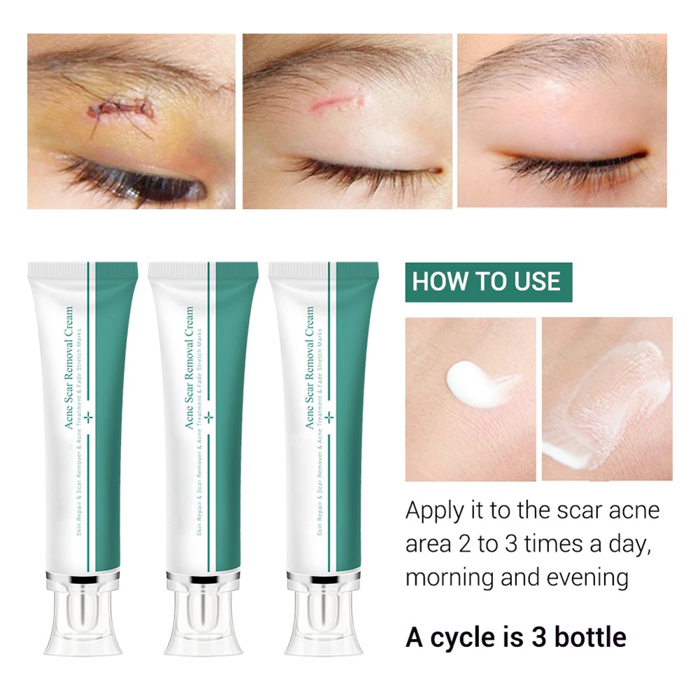 30 г крем для удаления шрамов от акне лица Уход за кожей шрам лечение удаление