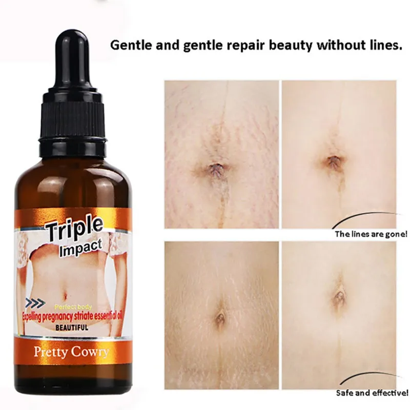 Средство для удаления эфирного масла уход за кожей Крем Для Удаления растяжек