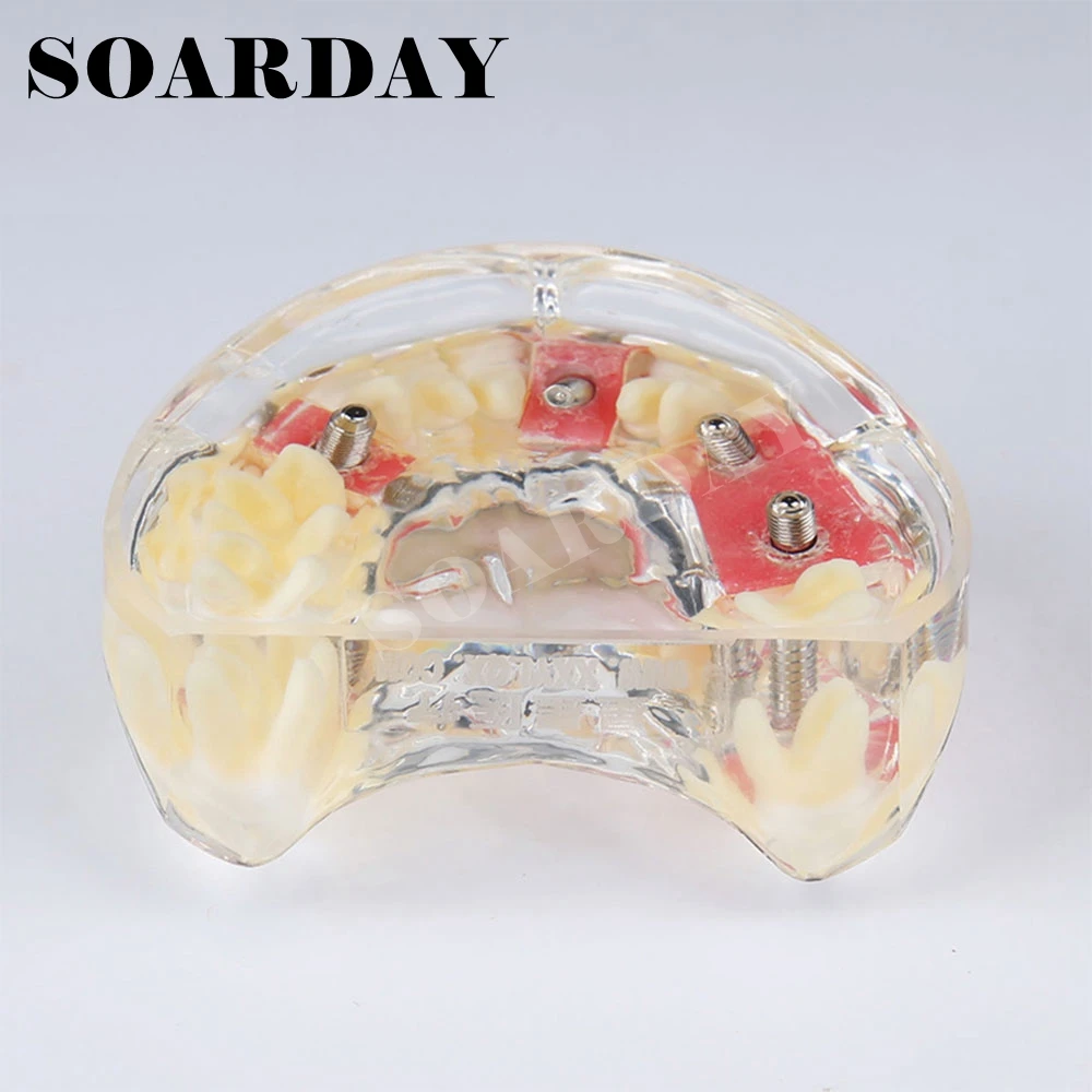

Implant Dental Model Teeth Gums Removable Demonstration Model