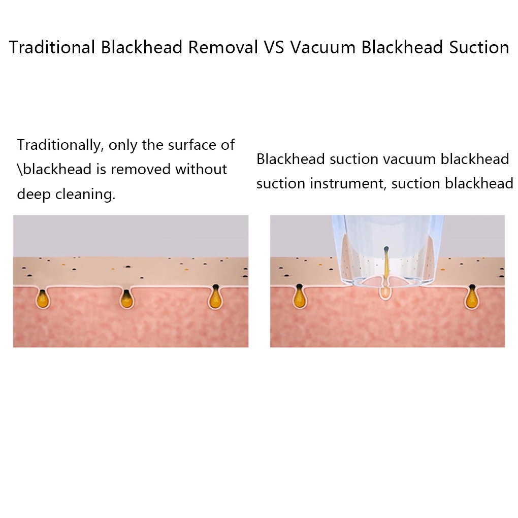 Инструмент для удаления угрей пор лица Очиститель красоты устройство USB
