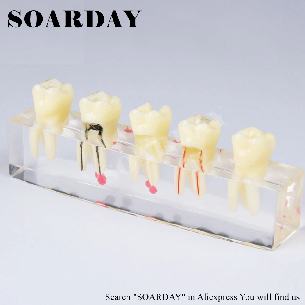 SOARDAY реставрация корневого канала зуба модель оральных стоматологических