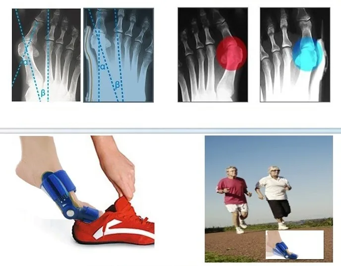 Ортопедические подтяжки для большого пальца при вальгусной деформации | Красота