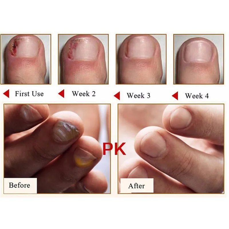 Natural Hand Nail Care Protector Skin Fungus Treatment Herb Antifungal Cream 15g | Красота и здоровье