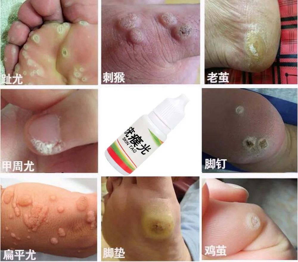 Body Warts Treatment Cream Skin Tag Remover Foot Corn Removal Plantar Genital Ointment Care 10ML |