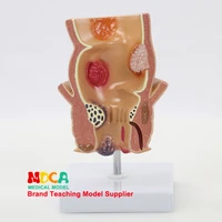 rectal model colon demonstration model teaching medical anorectal medicine mcw007
