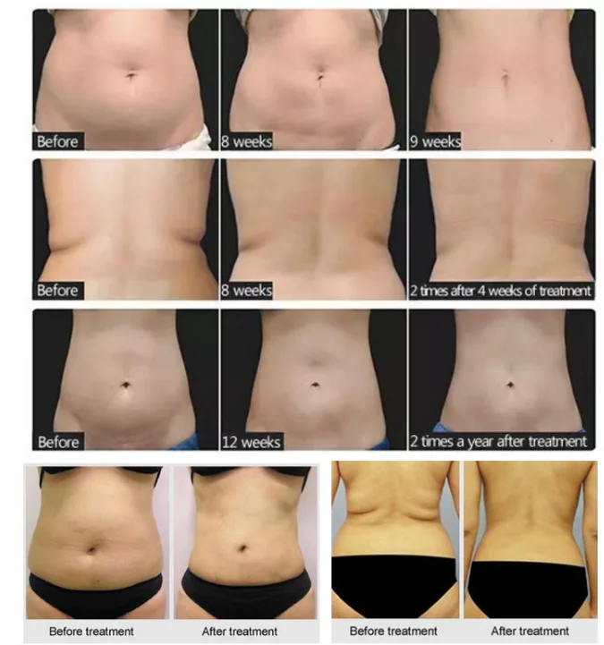 Lipo Laser+ Кавитация+ RF+ вакуумная/RF 40 K кавитационная вакуумная машина для похудения тела