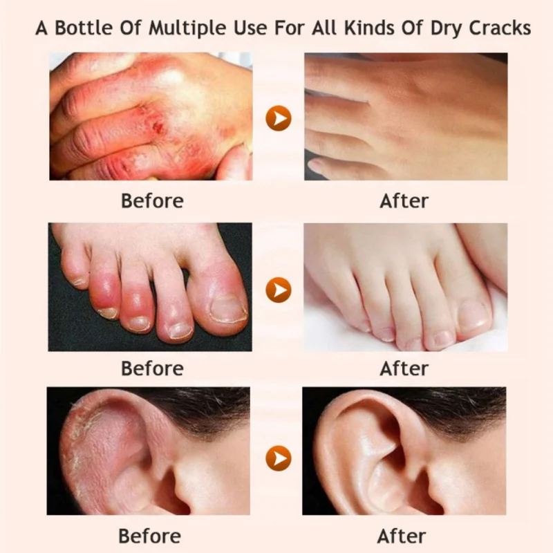ZhanTing 3 Pcs / Horse Oil Foot Cream Anti-Chapping Skin Repairing Moisturizer For Rough Dry And Cracked Chapped Feet Heel | Красота и