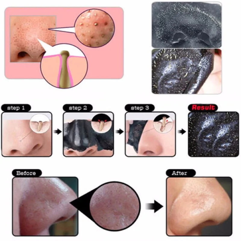 Черная маска на присоске для ухода за лицом носа и головы лучше чем лечение акне |