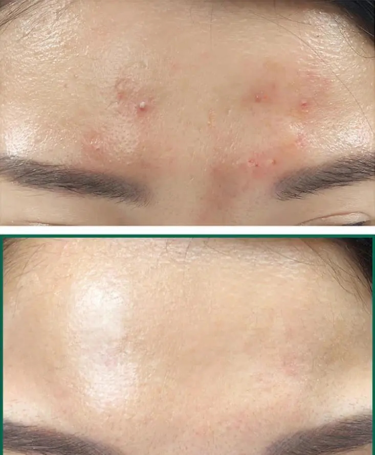Некоторые MI ана BHA ПГА 30 дней чудо крем + Сыворотки для лица косметический аппарат