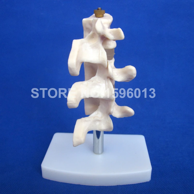 Горячая продвинутая модель остеопороза позвоночника повреждения в модели