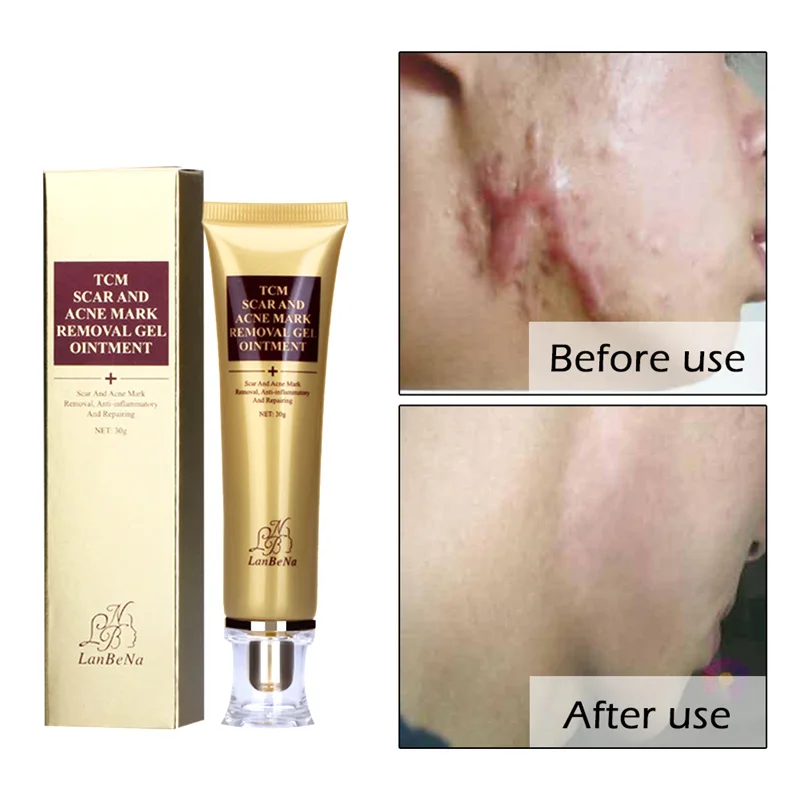 

5pcs/LANBENA Remove Acne Scars Repair Gel Red Spots Cream Moisturizing Skin Care Remove Blackhead Whitening Cream Stretch Marks