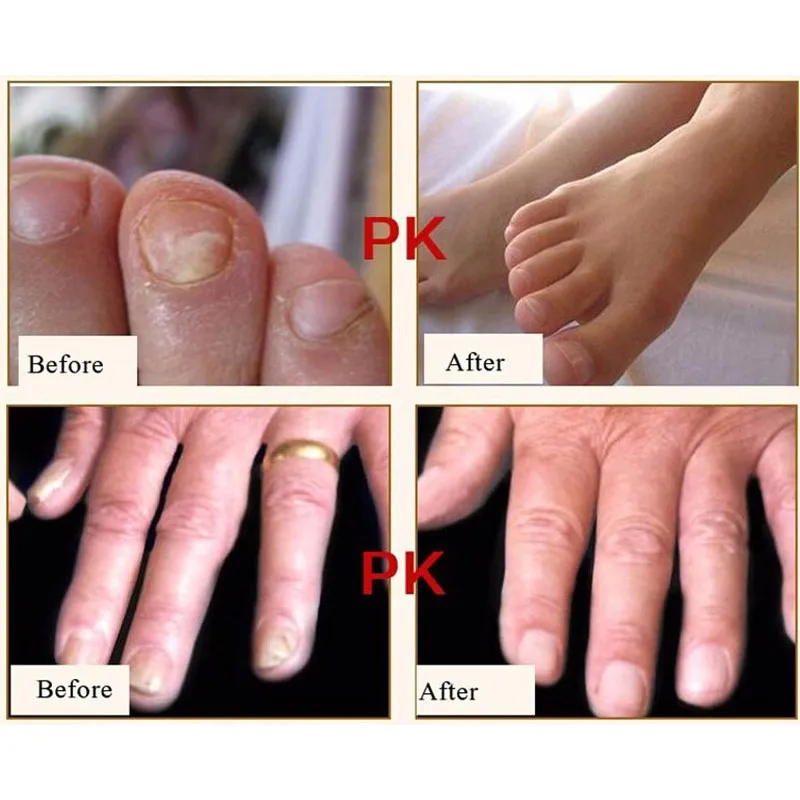 Natural Hand Nail Care Protector Skin Fungus Treatment Herb Antifungal Cream 15g | Красота и здоровье