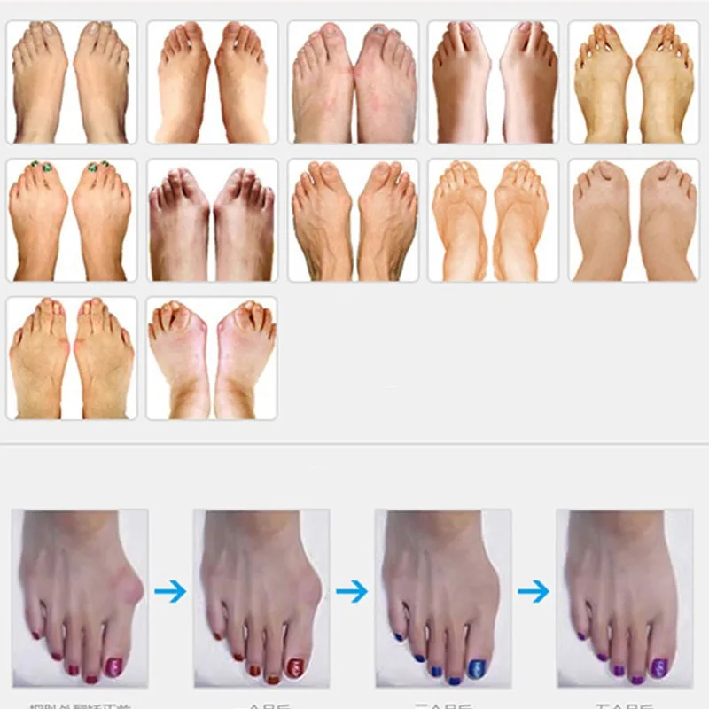 

100Pair Gel Toe Separator Stretchers Spacers Little Last Toe Valgus Corrector Gel Straightener Toe Aid Alignment Pain Relieve