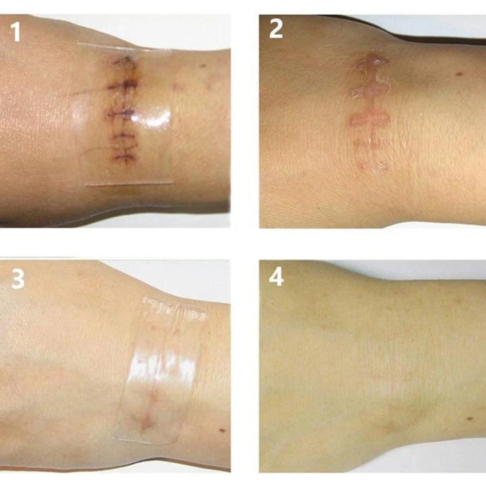 Reusable Silicone Scar Removal Patch Acne Gel Therapy Patch Remove Trauma Burn Sheet Body Skin Care Tools Scar Removal Patch