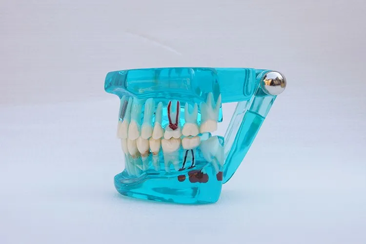 1 шт. модель зубного имплантата с восстановительным мостовым зубным стоматологом