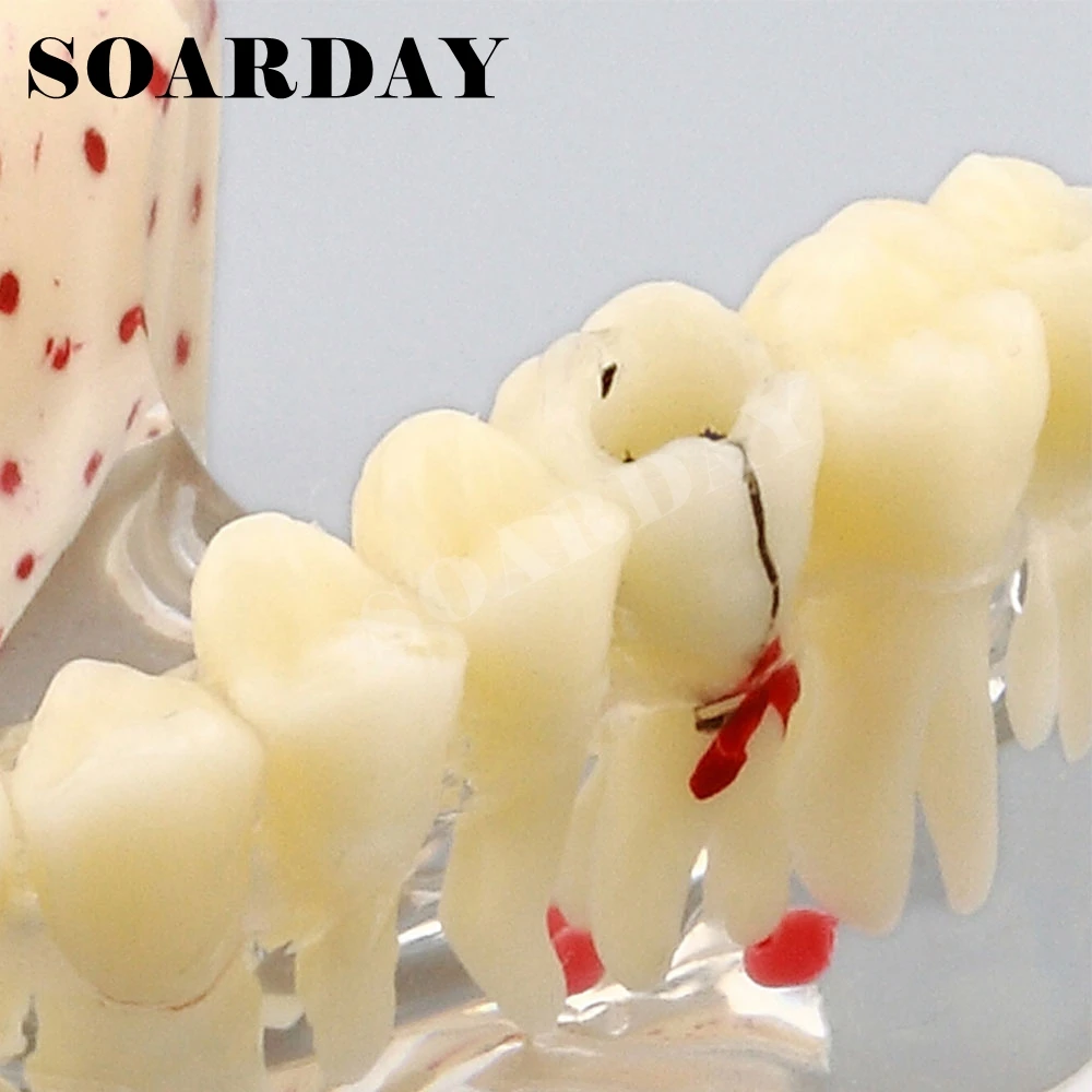 

Implant Dental Model for Upper teeth Implant Spongy Bone Carious