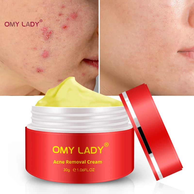Крем OMY LADY с многофункциональным эффектом устраняет морщины удаляет акне шрам