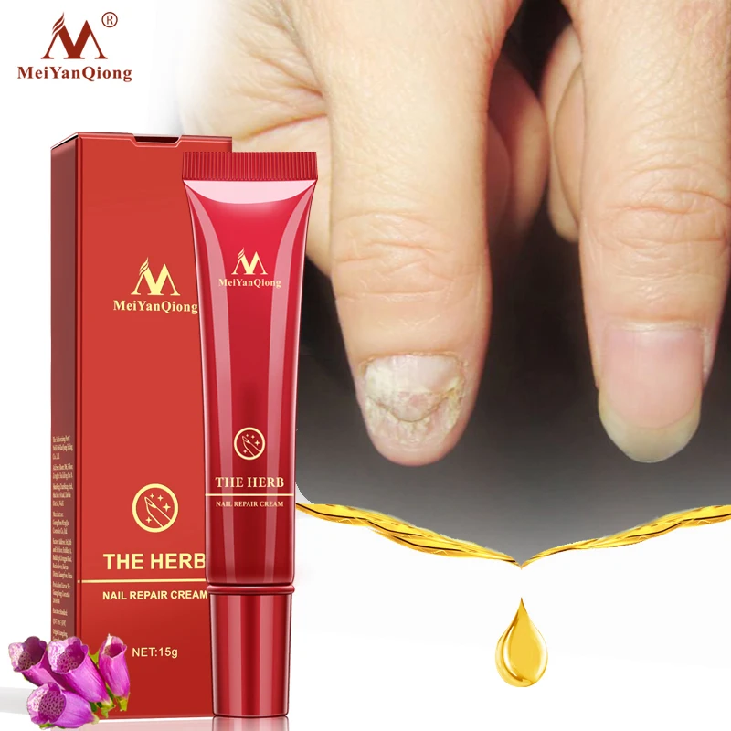 1 шт. травяной антигрибковый крем для лечения Ногтей с грибком пальцев ног