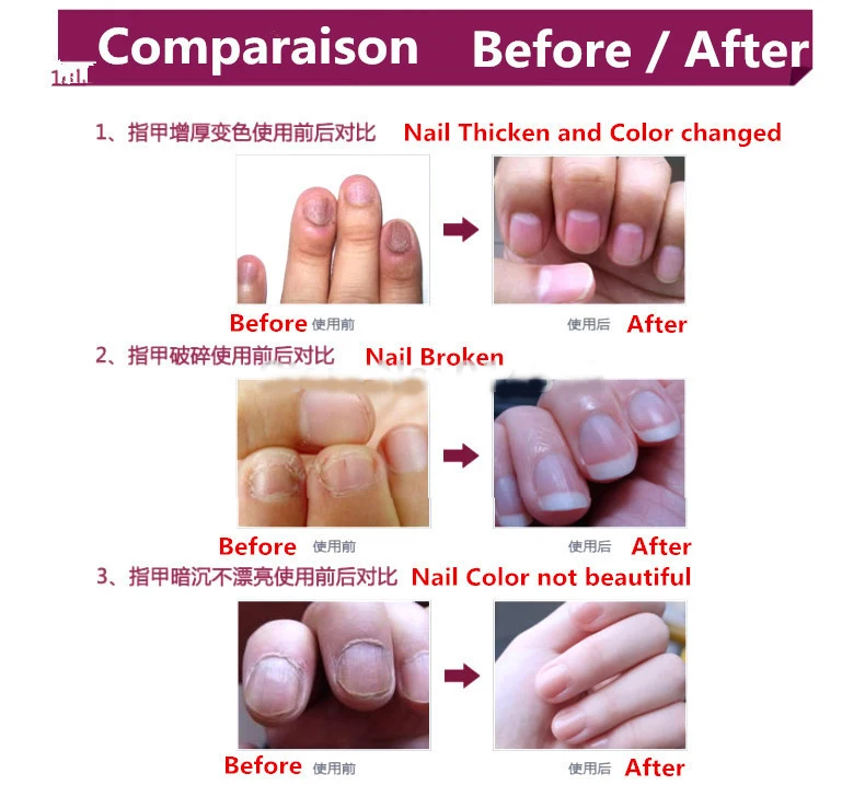 Chinese Medicine Plaster Nail Treatment Cream Onychomycosis Anti Fungal Infection Fights Bacteria Naturally ointment | Красота и