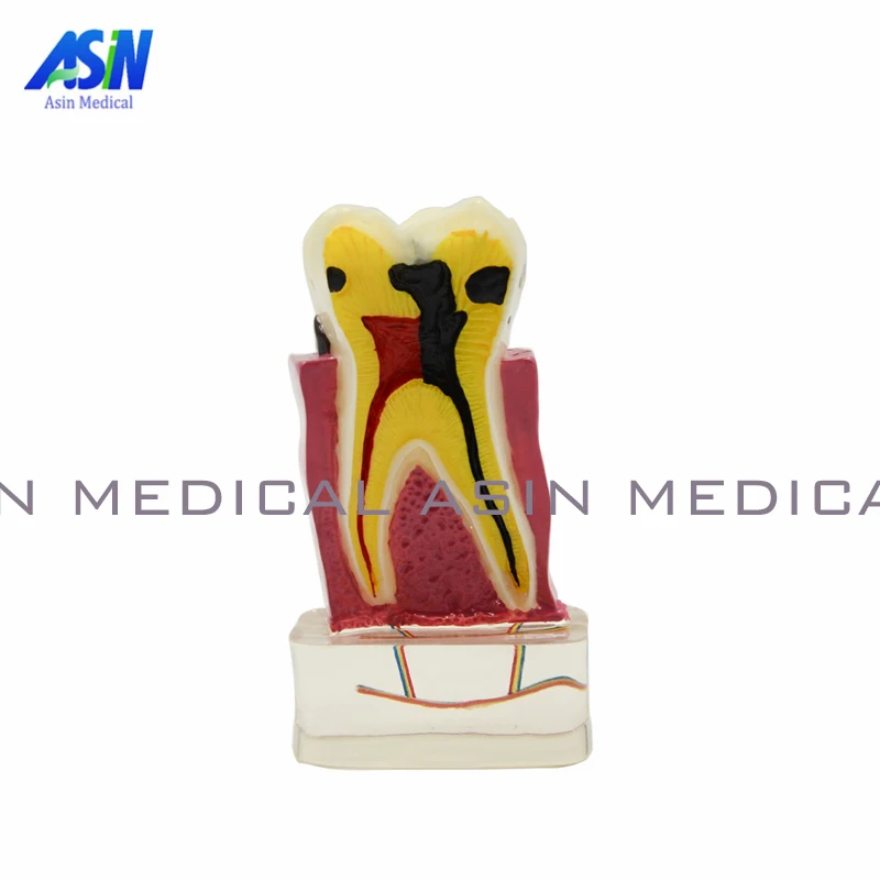 

Модель зубного протеза 4:1, стоматологическое обучение, модель зубного протеза