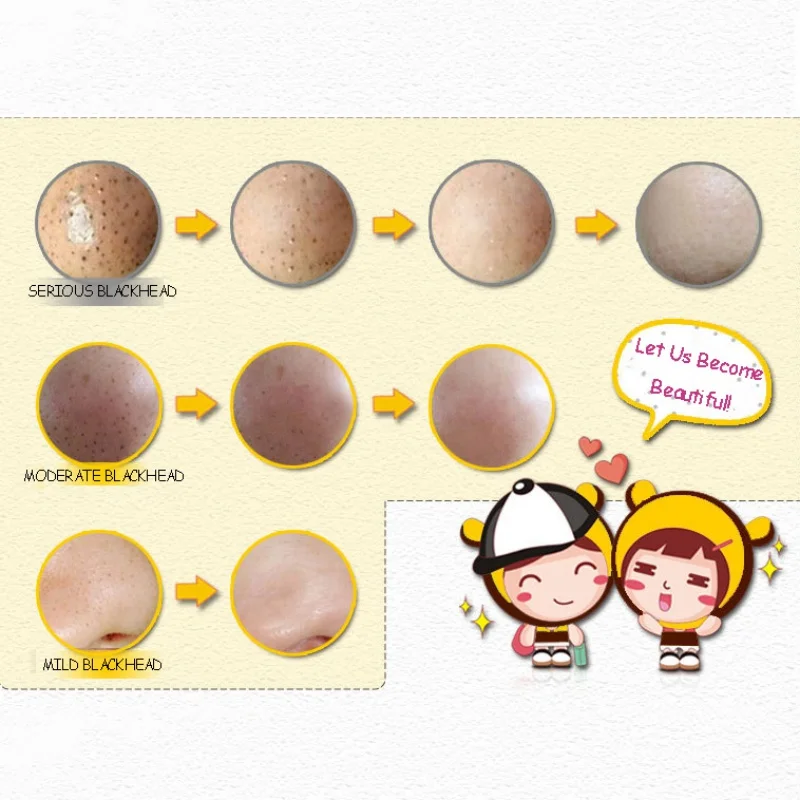 1 шт. женская маска для носа удаление угрей акне чистая черная головка 3 шага набор