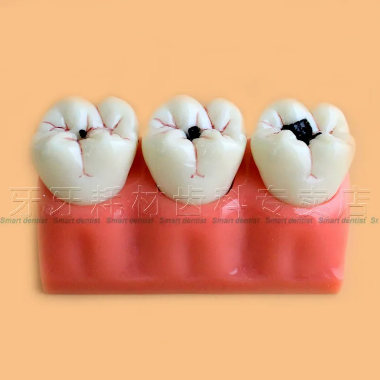

Good Quality Caries jewelry decomposition model of teaching evolution model Dental Teaching Study Model