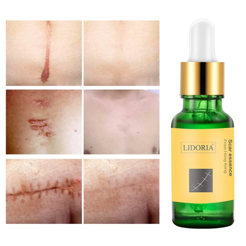 20 мл сглаживание кожи ремонт жидкость травма хирургии шрам рельефный уход за