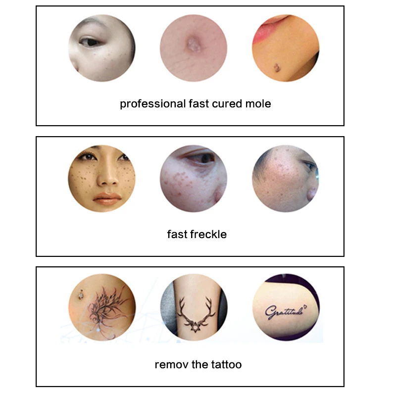 Лазерное Удаление Моль Инструменты Темно Пятновыводитель Веснушки Плазмы Ручку