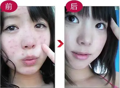 Эссенция для отбеливания и борьбы с прыщами 40 г|essence|essence 4 |