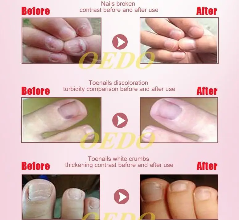 Грибковые Ногтей Лечение TCM Сущность Масло Руки и Ноги Отбеливающий Грибок Ногтя