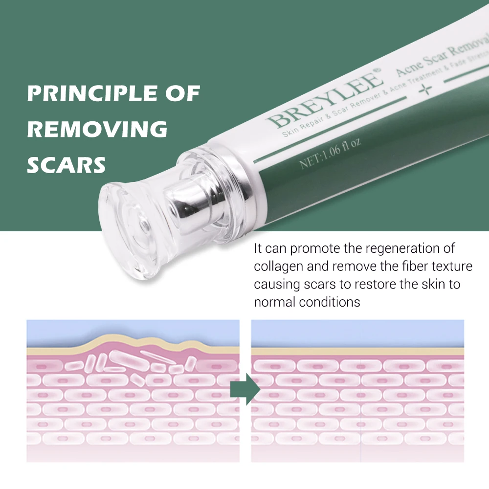 BREYLEE удаление шрамов крем уход за кожей лица от угревой сыпи шрам стрейч Знаки