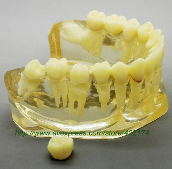 

Free Shipping 2times adult pathologies model dental tooth teeth anatomical anatomy model odontologia