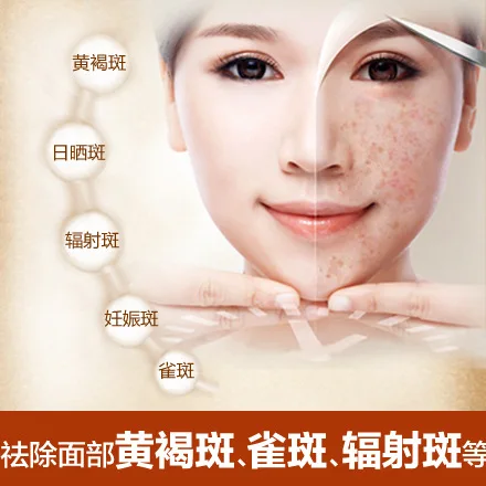 Удаление веснушки крем хлоазма 30 день Отбеливание исчезают темные пятна Уход за